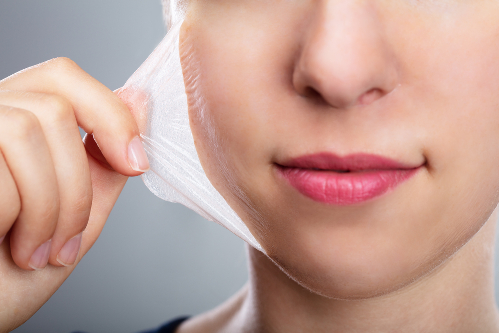 best chemical peel for acne scars and large pores